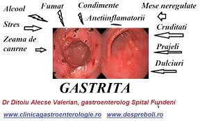 Gastrita – semne, simptome, diagnostic