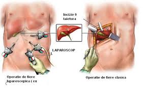 Operatia de fiere "cu laser"- colecistectomia laparoscopica