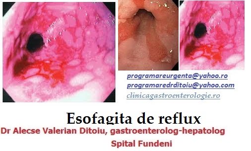 Regimul alimentar in esofagita, refluxul gastroesofagian, hernie hiatala